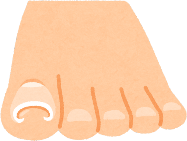 Illustration of an Ingrown Toenail